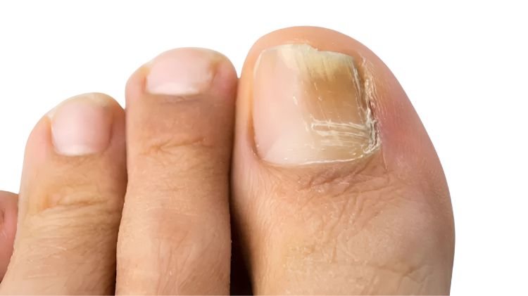 Tratamento de onicomicose com laser em BH – micose de unha sem dor